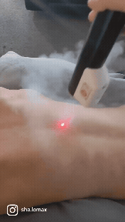 Close-up of localised cryotherapy treatment